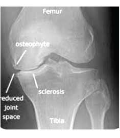 X ray Knee AP view-OA