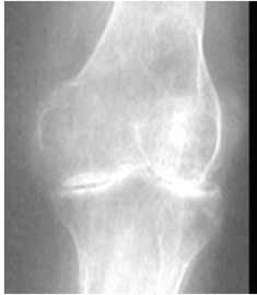 X ray Knee AP view-RA