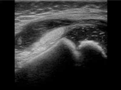 Synovial thickening and Effusion